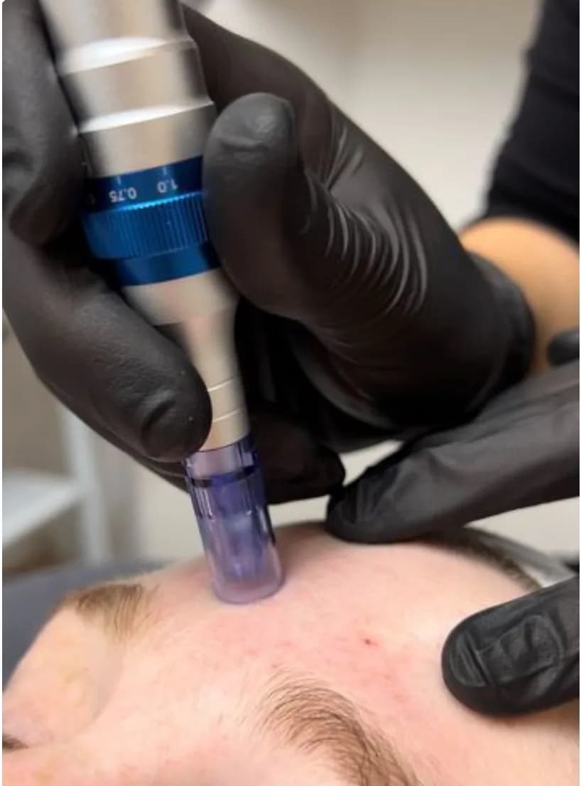 Microneedling — Nanopore & Dermapen