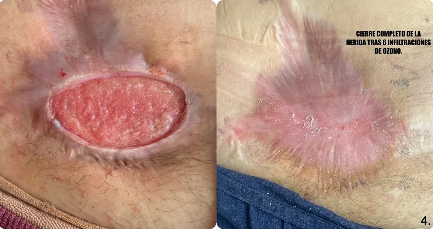 Ozonoterapia para heridas que no cierran: qué se sabe y qué no - Blog de medicina estetica